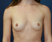 Feel Beautiful - Breast Augmentation Case 44 - Before Photo